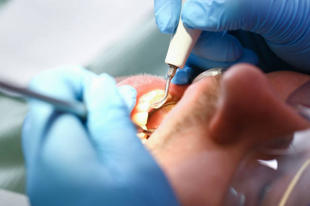 Best Emergency Tooth Extraction in Black Diamond, FL